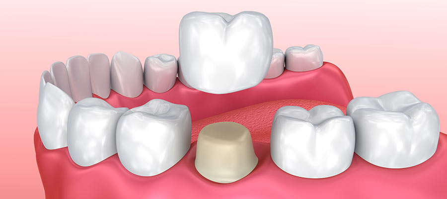 Dental Crowns Specialist Near Me in Los Angeles, CA