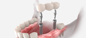 Dental Bridges Specialist Near Me in Los Angeles, CA