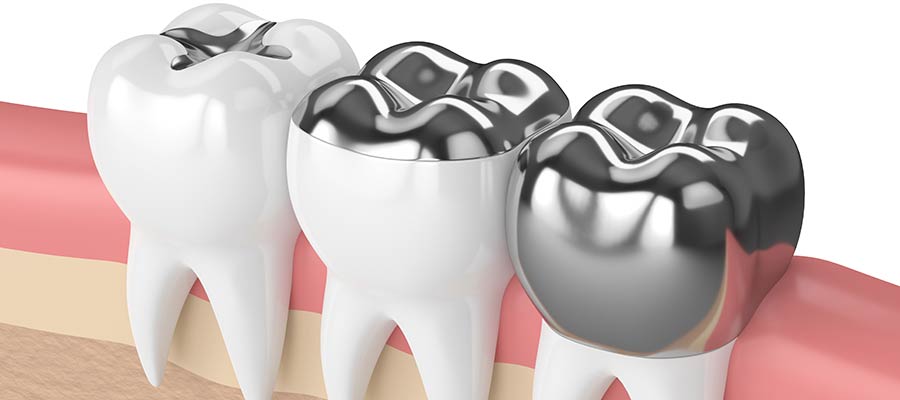 Dental Inlays and Onlays Near Me Serving Santa Monica, Los Angeles, CA