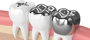 Dental Inlays and Onlays Near Me in Mar Vista, Los Angeles, CA