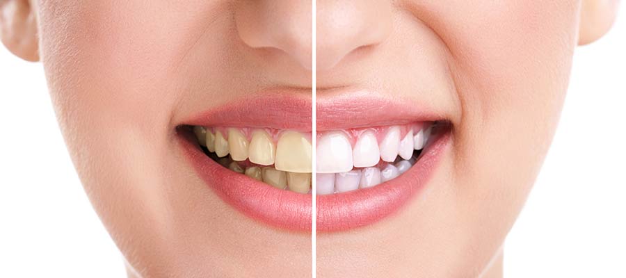 Teeth Whitening Specialist Near Me in Los Angeles, CA