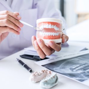 Porcelain Crown Dentist at Santa Monica, Los Angeles, CA