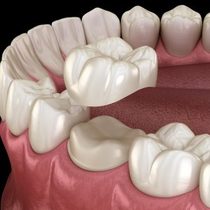 Single Crown Treatment at Santa Monica, Los Angeles, CA.