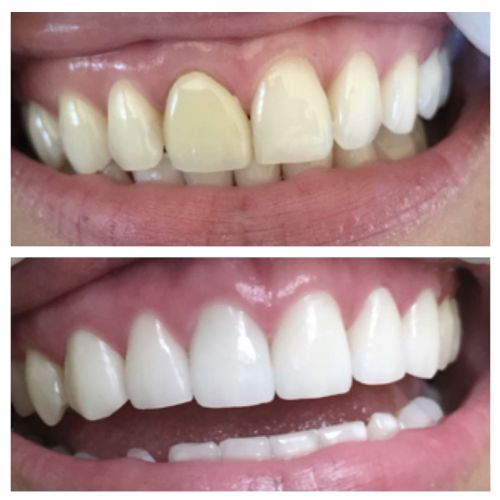 Before & After Smile Transformations at Le Chic Dentist Serving Santa Monica, Los Angeles, CA