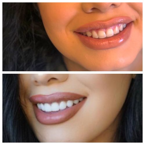 Before & After Smile Transformations at Le Chic Dentist Serving Santa Monica, Los Angeles, CA