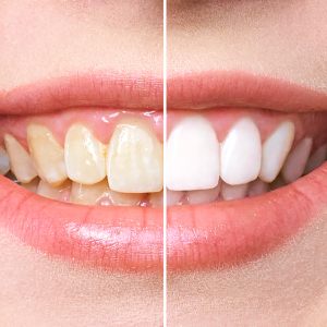Before and After Images at Le Chic Dentist Serving Santa Monica, Los Angeles, CA
